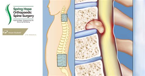 Early Surgery in Spinal Cord Compression from Spine Tumor Gives in Better Outcome - Orthopaedic ...