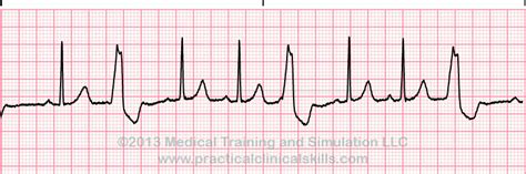 trigeminal rhythm – Liberal Dictionary