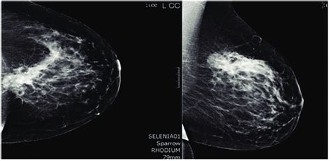 Mammogram. A core biopsy was done of this mass and it showed poorly... | Download Scientific Diagram