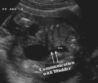 Omphalomesenteric Duct (Vitelline Duct) Cysts