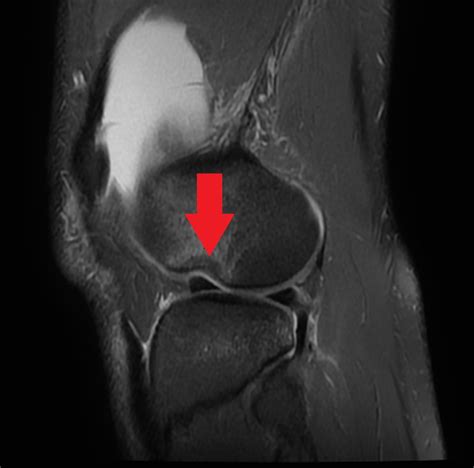 Lateral femoral notch sign - ACL tear | Image | Radiopaedia.org