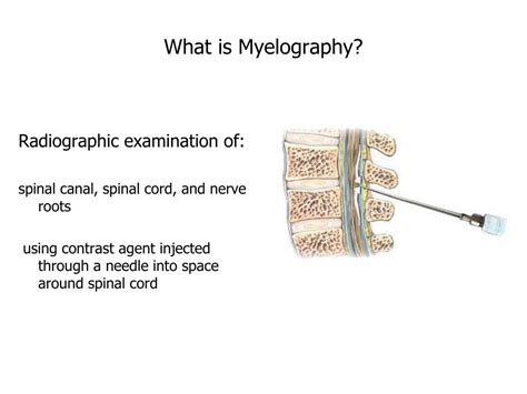 PPT - What is Myelography? PowerPoint Presentation, free download - ID ...