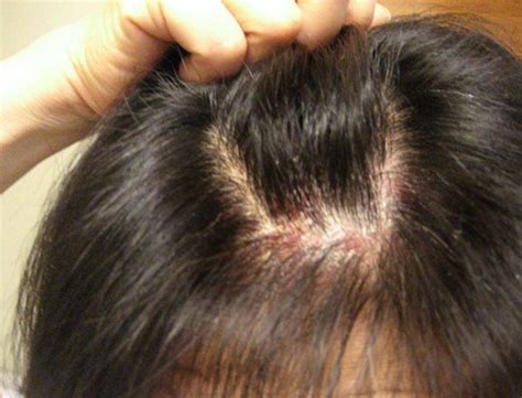 Itchy Scalp - Symptoms, Hair loss, Causes, Treatment | HubPages