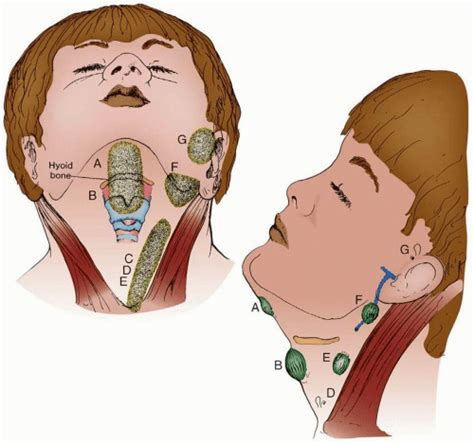 Thyroglossal Duct Cysts and Branchial Cleft Cysts | Obgyn Key