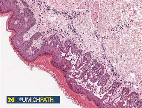 Michigan Pathology on Twitter: "Are you ready for this week's #CaseoftheWeek? 30 y/o female ...