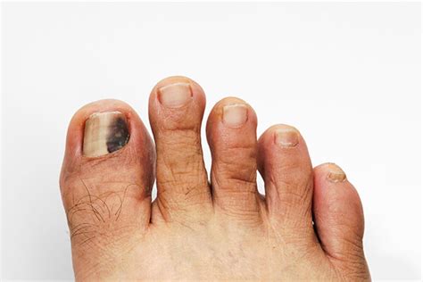 Black Spot On Toenail: Learn About Its Development And Treatment