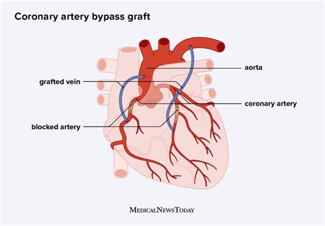 Heart bypass surgery: Procedure, recovery time, and risks