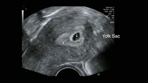 Ultrasound 5 Weeks Gestation |Early pregnancy scan | - YouTube