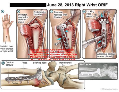 AMICUS Illustration of amicus,surgery,wrist,orif,incision,volar,aspect,pronator,quadratus,lifted ...