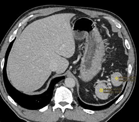 Multiple Accessory Spleens in Patient s/p Splenectomy - Spleen Case ...