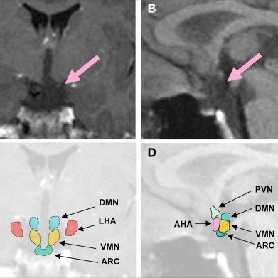 Representative coronal (A), midsagittal brain MRI (B), and schematic ...