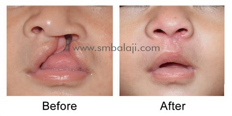 Cleft lip surgery in India | No.1 Best Cleft Lip Surgeon