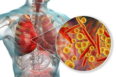 Qué es el Mycoplasma y cuáles son sus síntomas