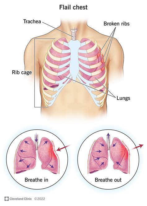 Flail Chest: Causes, Symptoms, Diagnosis & Treatment