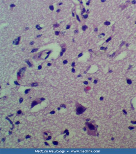 Rasmussen syndrome | MedLink Neurology