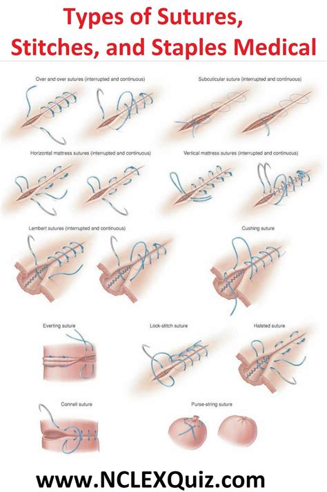 Types of Sutures, Stitches, and Staples Medical Wound Care Suturing Techniques Removing Stitches ...