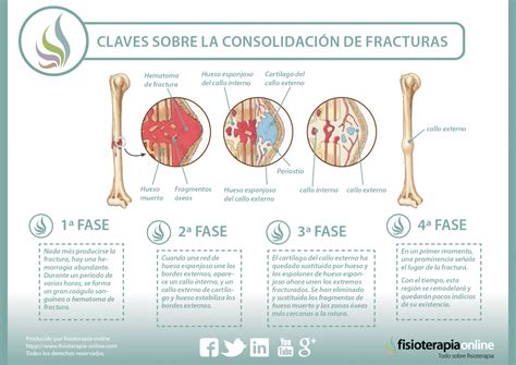 ¿Sabes cómo se consolidan o recuperan las fracturas de huesos? Descubre cómo ocurre | FisioOnline