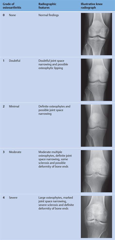 Osteoarthritis Classification | My XXX Hot Girl