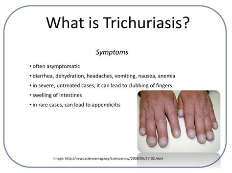 PPT - Trichuriasis PowerPoint Presentation - ID:4683431