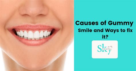 Causes of Gummy Smile and Ways to fix it - SKY Dental Vijayawada