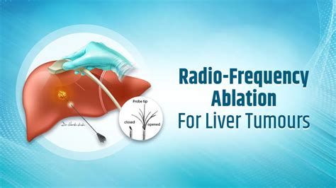 Radiofrequency Ablation (RFA) for Liver Tumours - Dr. Harsh J Shah