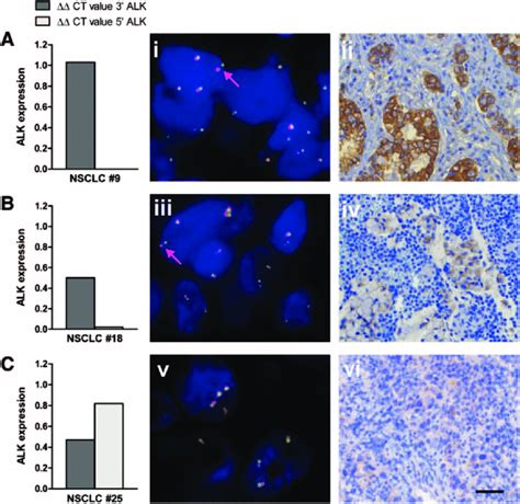 Comparative analysis of ALK by qRT-PCR measuring the expression of the ...