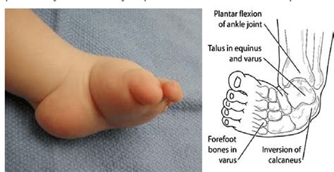 CONGENITAL TALIPES EQUINOVARUS (CTEV) - PHYSIOFEEDS