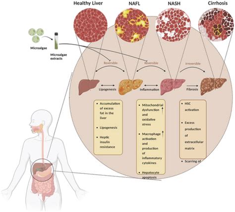 Stages of NAFLD development and progression. NAFLD refers to a range of ...