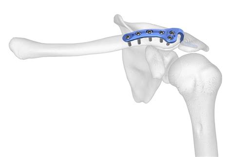 EL-Clavicle-Plating-System-Hook-Plate-on-bone | Acumed