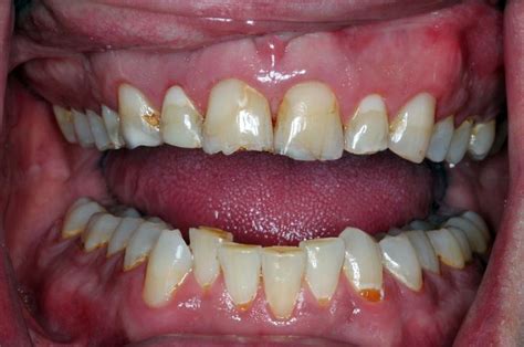 The Truth About Soda and Acid Erosion on Teeth | Directorio Odontológico