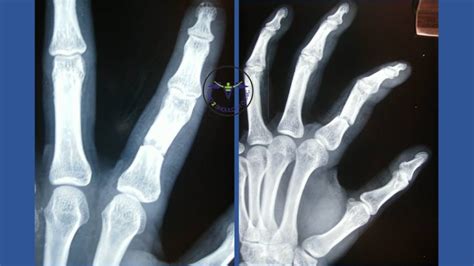 proximal phalanx fracture | Hand2Shoulder Clinic