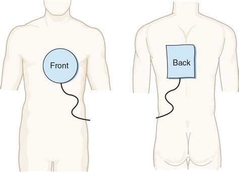 Cardiac Pacing | Anesthesia Key