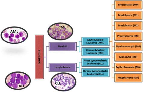 Major types of leukemia: AML- acute myeloid leukemia; ALL- acute ...