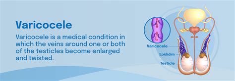 Varicocele | What Is a Varicocele? | TXVWI