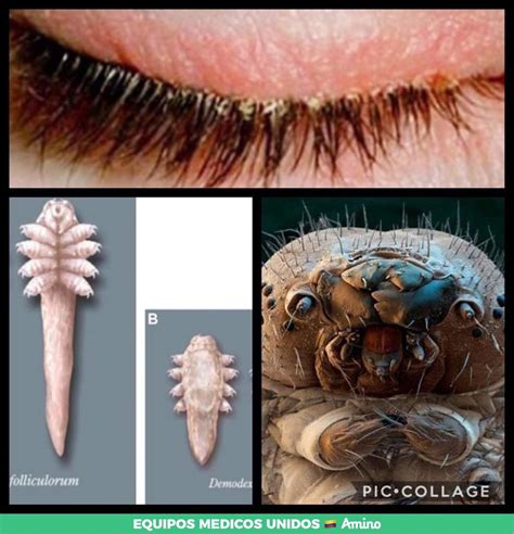 Demodex Folliculorum Mites