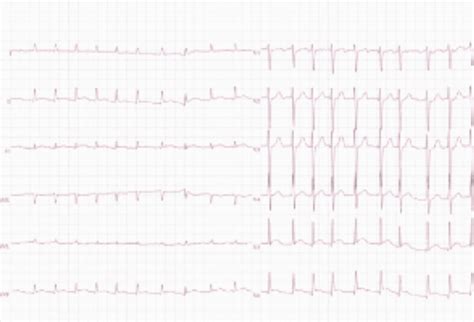 Diltiazem vs Métoprolol dans la FA aiguë avec insuffisance cardiaque : verdict - Actusantemag