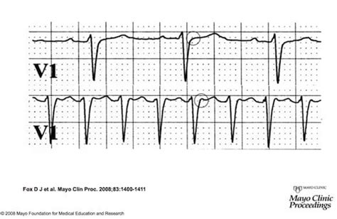 AVNRT for two • LITFL • ECG Library Diagnosis