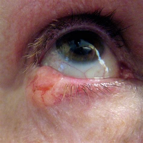 Basal Cell Carcinoma On Lower Eyelid