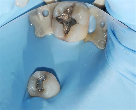 Amalgam Fillings Removal | Replacing Amalgam Fillings | Filling Removal