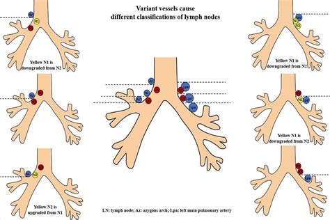 Paratracheal Lymph Nodes Lung Cancer