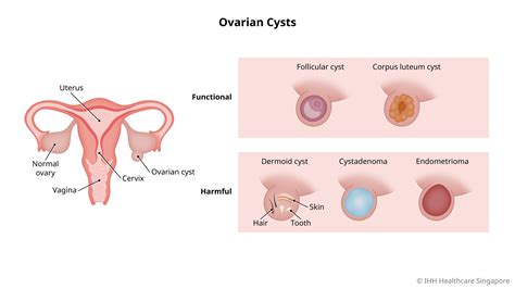 Ovarian Cysts - Symptoms & Causes | Parkway Shenton