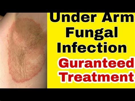 Under arms infection #fungal infection# bacterial infection# burning#itching#inflammation - YouTube