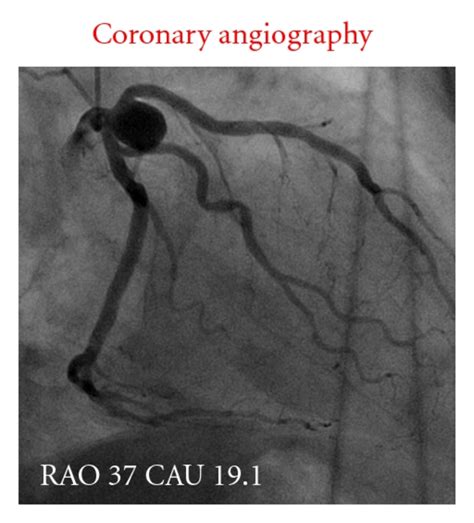 Images of the coronary aneurysm by coronary angiography ((a)–(d)) and... | Download Scientific ...