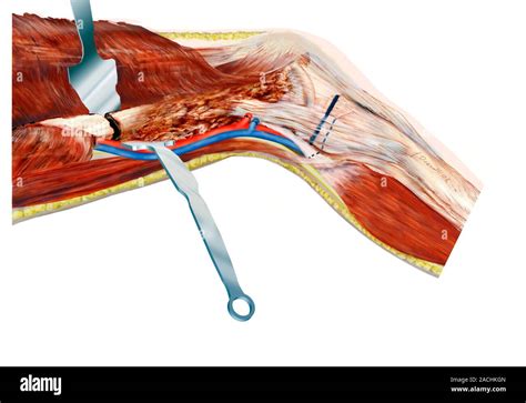 Knee cancer surgery. Artwork showing a stage in the surgical treatment ...