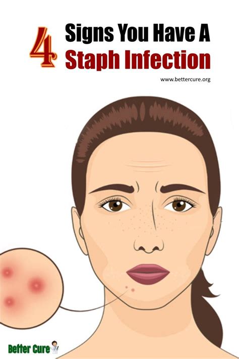 4 Signs You Have A Staph Infection | Staph infection, Staph infection ...