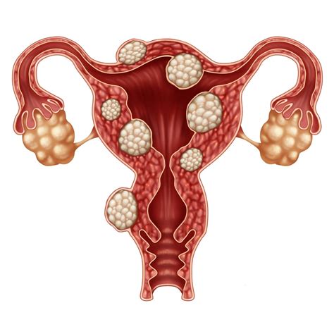 Elagolix Reduces Menstrual Bleeding in Women With Uterine Fibroids ...