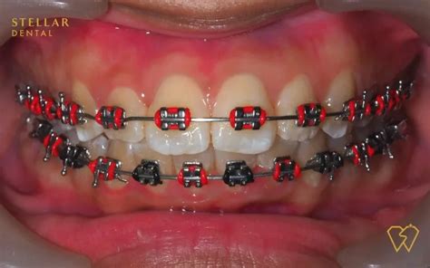 Braces Colors: Top Picks For 2023 - Stellar Dental