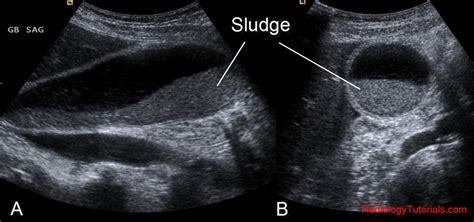 WK 3 Liver & Gallbladder (Gallbladder sludge - Ultrasound, Ultrasound ...