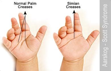 Aarskog–Scott Syndrome - Causes - Symptoms - Diagnosis - Treatment - FAQs