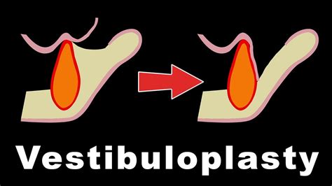 Vestibuloplasty - Kazanjian, Lip Switch, Clark's, Maxillary Pocket inlay - YouTube